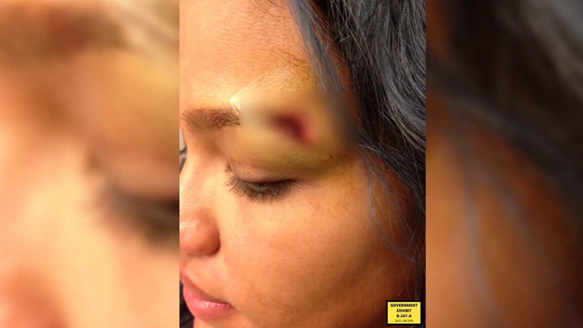 Cassie Ventura injury