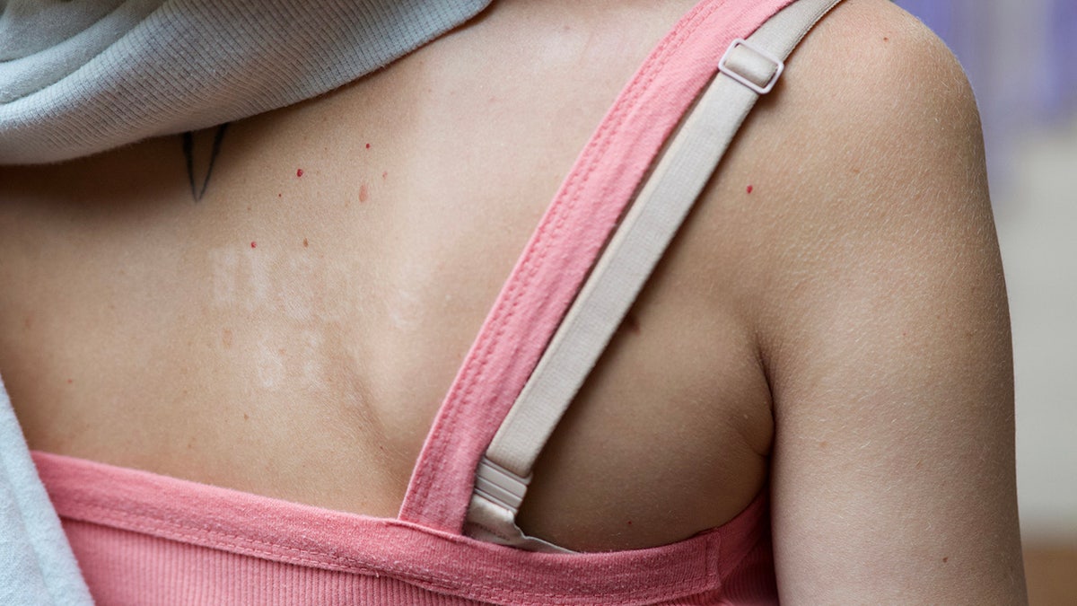 Sherri Papini's back showing branding marks.