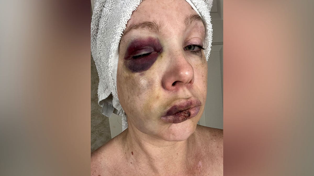 The battered and bruised face of Cincinnati beating victim, known only as Holly.
