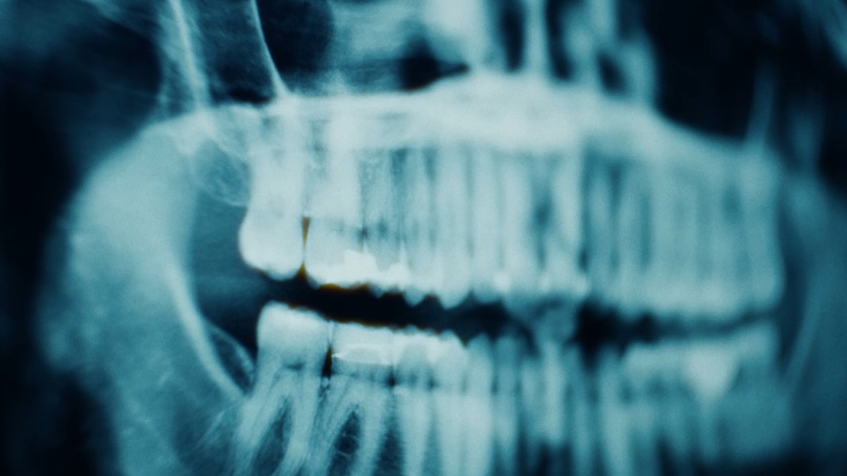 A close-up of dental X-rays.