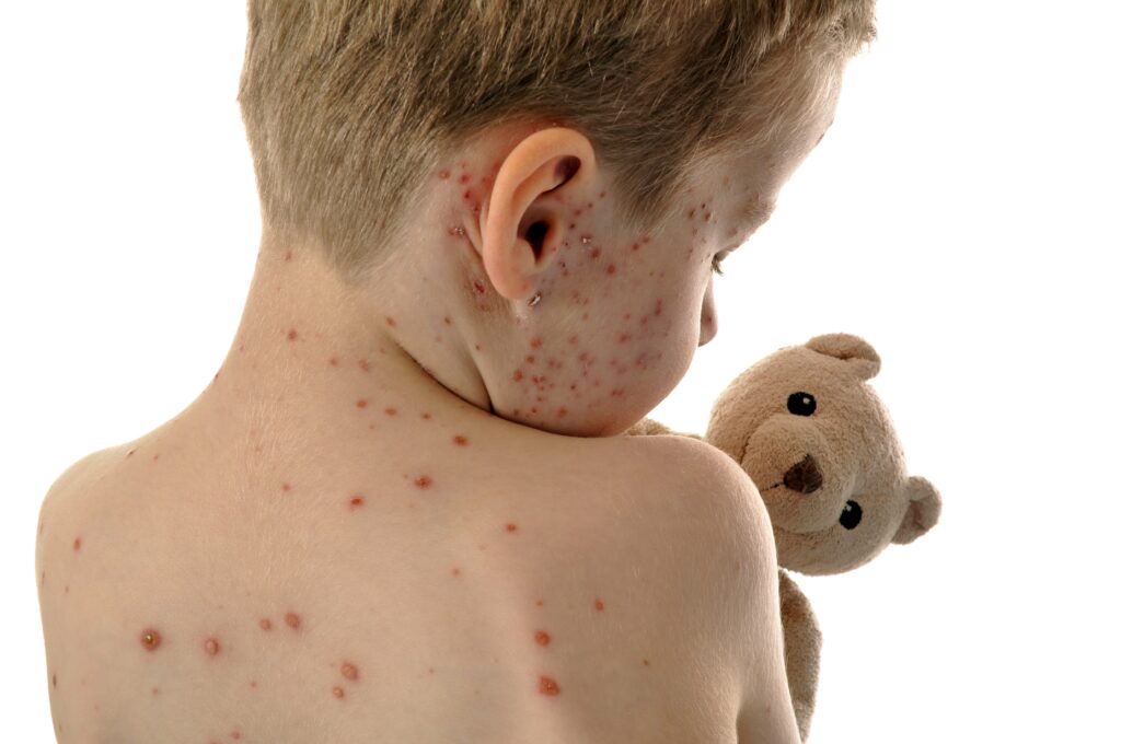 Measles Outbreak In South Carolina Measles Outbreak In South Carolina